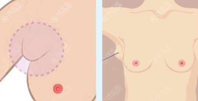 副乳切除选微创好还是开刀好 副乳切除选微创好还是开刀好