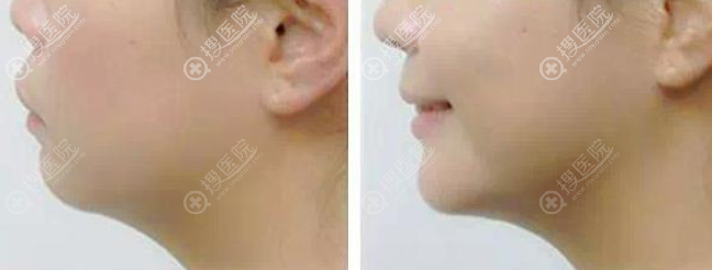 自体脂肪填充下巴案例 自体脂肪填充下巴案例