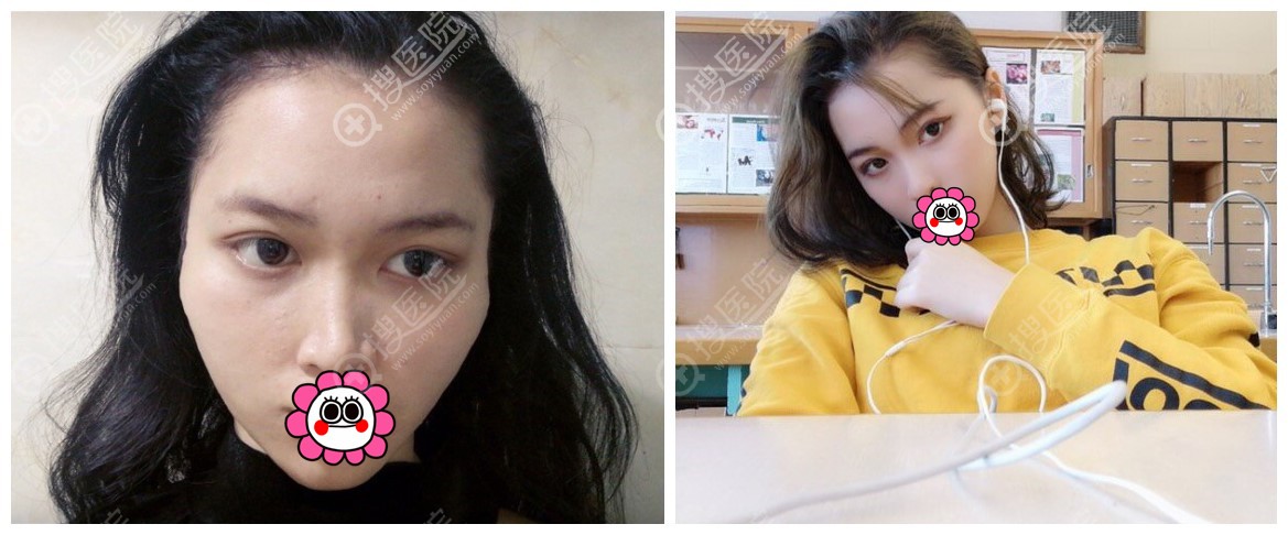 重庆时光姜民范颧骨内推案例 重庆时光姜民范颧骨内推案例