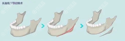 长曲线下颌角截骨示意图 长曲线下颌角截骨示意图
