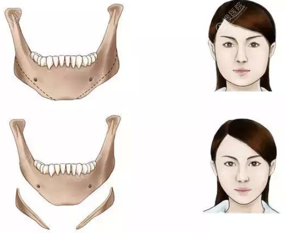 长曲线下颌角截骨多少钱? 长曲线下颌角截骨多少钱?