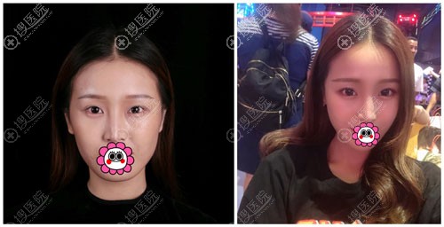 意大利悦升线多久能看到效果 意大利悦升线多久能看到效果