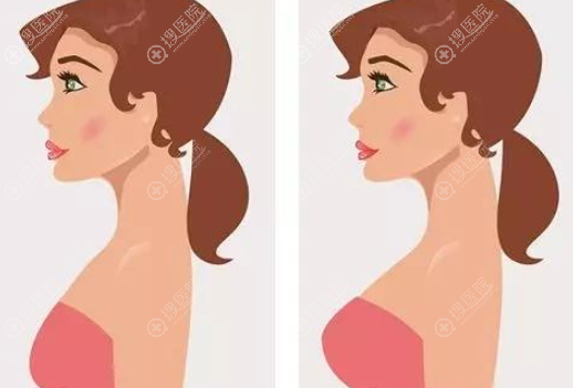 假体隆胸前后对比效果 假体隆胸前后对比效果