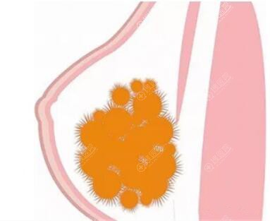 取乳房奥美定手术要花多少钱?不过奥美定取出选择医院需慎重