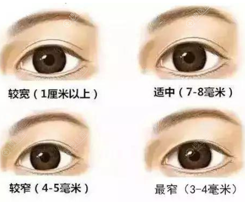 双眼皮做了7mm恢复后感觉好宽,那自然的双眼皮宽度是多少毫米