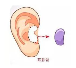 隆鼻选单侧耳软骨好还是双侧好 隆鼻选单侧耳软骨好还是双侧好