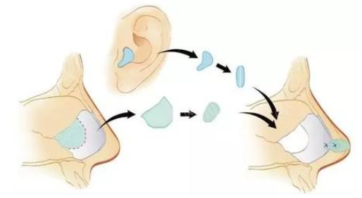 耳软骨隆鼻示意图 耳软骨隆鼻示意图
