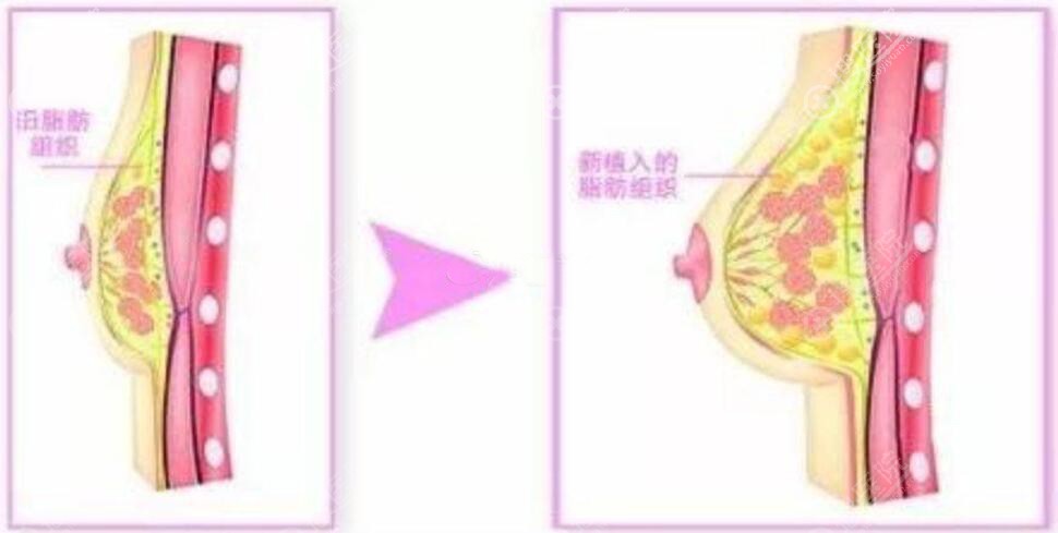 自体脂肪隆胸效果怎么样? 自体脂肪隆胸效果怎么样?