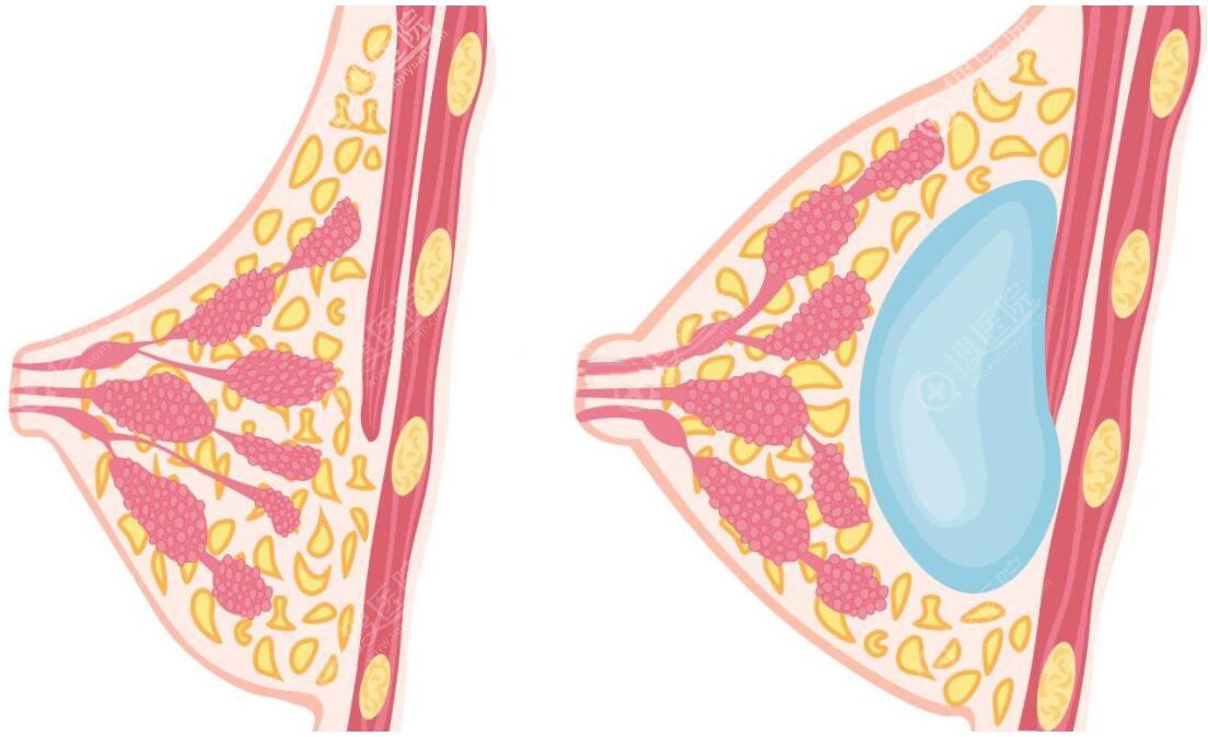假体隆胸效果怎么样 假体隆胸效果怎么样