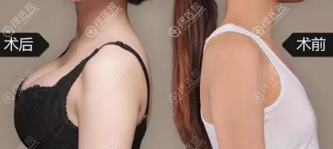 假体隆胸对比效果图 假体隆胸对比效果图