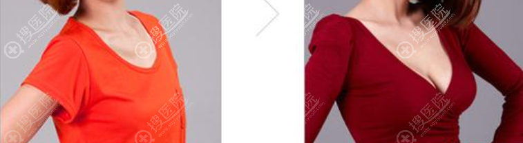 法国ES胸假体多少钱?伊思雅假体手感怎么样决定了效果好不好