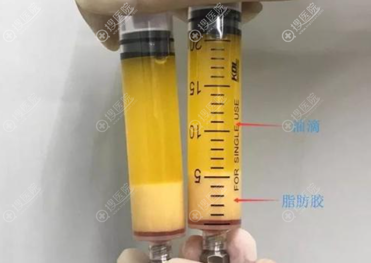 脂肪胶存活率高吗 脂肪胶存活率高吗