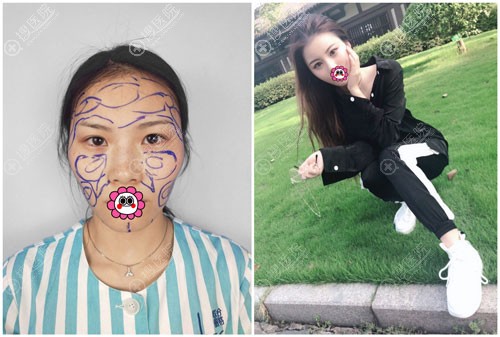 脂肪胶填充对比效果图 脂肪胶填充对比效果图