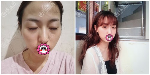 颧骨颧弓一起做效果图 颧骨颧弓一起做效果图