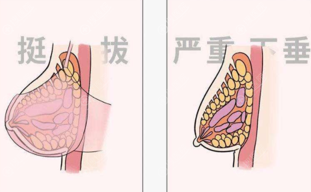 人工韧带乳房提升术效果怎么样? 人工韧带乳房提升术效果怎么样?