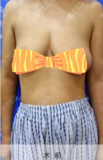 做人工韧带乳房上提术前 做人工韧带乳房上提术前