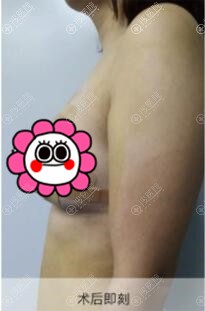 人工韧带乳房提升术后效果 人工韧带乳房提升术后效果