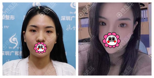 不开刀降颧骨对比效果图 不开刀降颧骨对比效果图