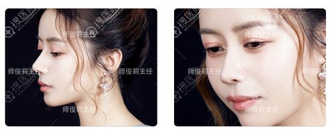 师俊莉做的鼻子真的好吗 师俊莉做的鼻子真的好吗