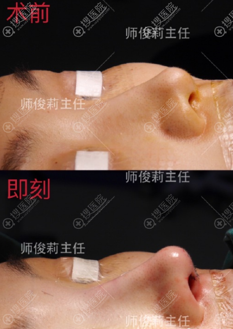 师俊莉鼻修复效果图片 师俊莉鼻修复效果图片