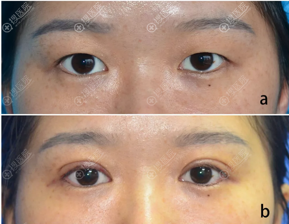 保留血管双眼皮术后七天效果 保留血管双眼皮术后七天效果