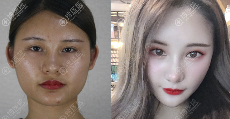 成都李继华磨骨怎么样看颧骨下颌角效果图 成都李继华磨骨怎么样看颧骨下颌角效果图