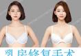 韩国原辰朴原辰院长告诉您 假体隆胸下移怎么样修复较理想