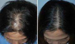 头发稀少的原因及治疗方法