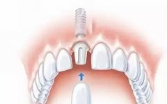 纯钛种植牙要多少钱一颗