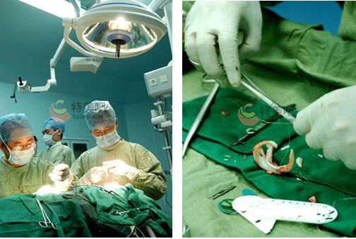 外耳再造手术医生操作 外耳再造手术医生操作