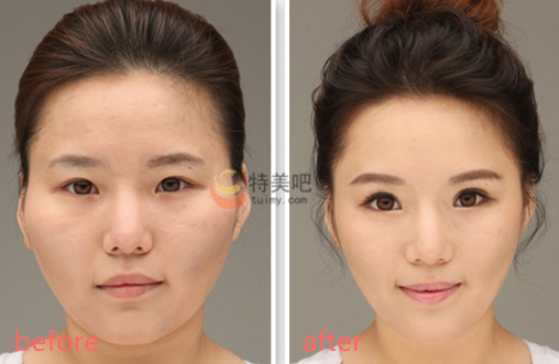 颧骨颧弓整形术 颧骨颧弓整形术