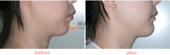 上颚前突矫正手术 上颚前突矫正手术