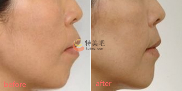 上下颚手术/突嘴矫正案例 上下颚手术/突嘴矫正案例