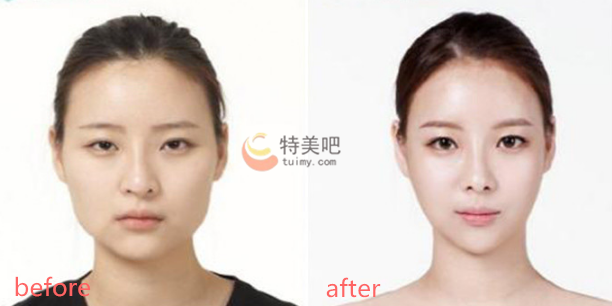 V-LINE瓜子脸手术案例 V-LINE瓜子脸手术案例