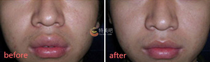 厚唇改薄案例 厚唇改薄案例