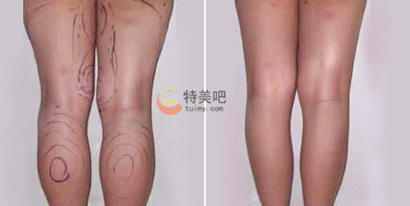 吸脂瘦大腿案例 吸脂瘦大腿案例