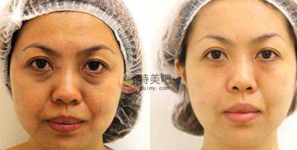 童颜针案例分享 童颜针案例分享