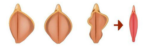 小阴唇手术 小阴唇手术