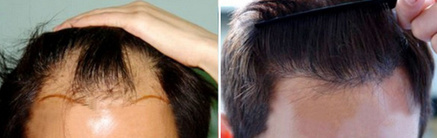 种植发际线案例 种植发际线案例