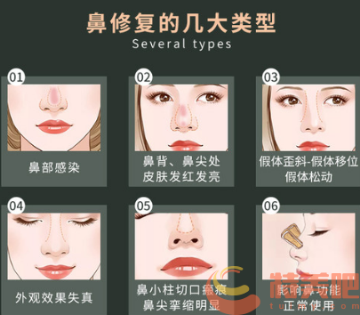 北京鼻修复有哪些情况 北京鼻修复有哪些情况