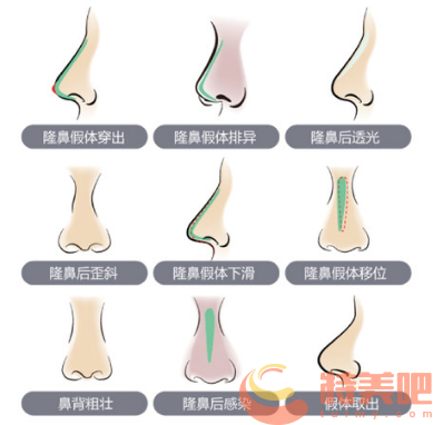 鼻子失败 鼻子失败