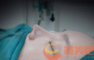 隆鼻修复即刻 隆鼻修复即刻