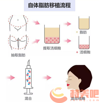 自体脂肪填充面部 自体脂肪填充面部