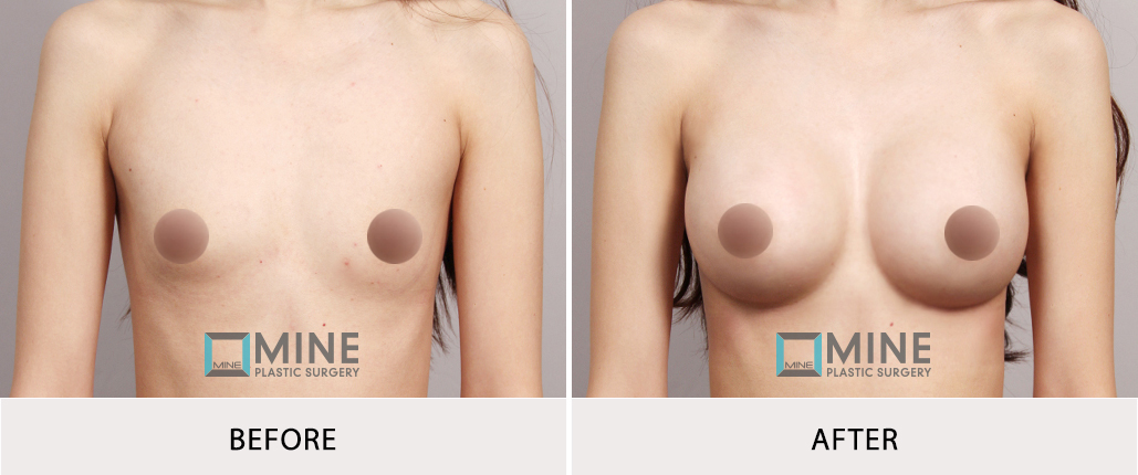 물방울 가슴성형