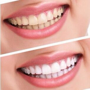 烤瓷牙和全瓷牙价格分别多少