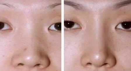 深圳做假体隆鼻的价格