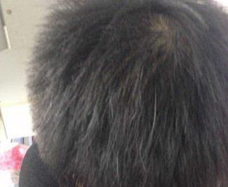 年轻人雄性脱发