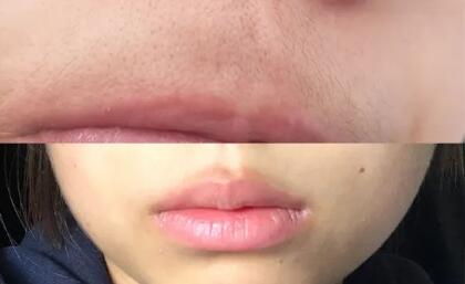 乌鲁木齐激光脱毛价钱