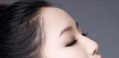 隆鼻尖用什么方法好