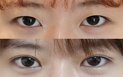 刚割了双眼皮能吃虾吗